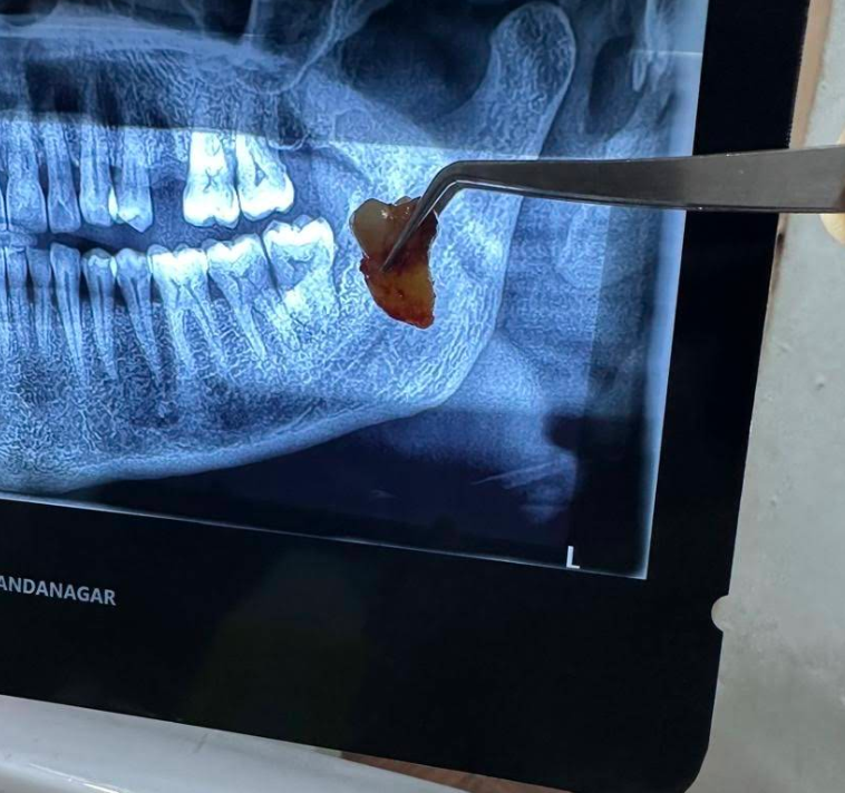 Safe and painless tooth extraction